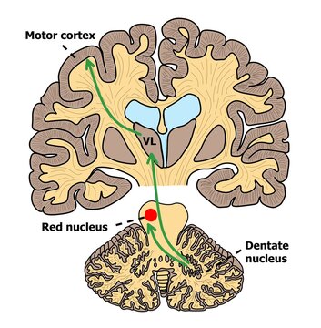 the tract of thalamic ataxic control connection between thalamus, cerebellum and frontal cortex.