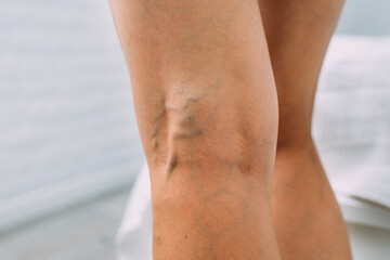 Legs with woman with varicose veins and pronounced mesh
