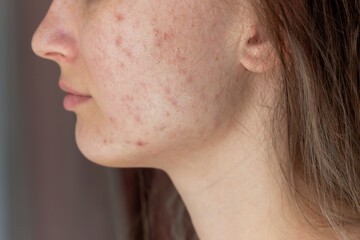 Cropped shot of a young woman's face in profile with problem of acne. Pimples, red scars on cheeks and chin. Allergies, dermatitis, rash. Problem skin, care and beauty concept.Dermatology, cosmetology - obrazy, fototapety, plakaty
