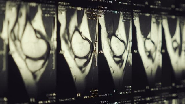 Magnetic resonance imaging (MRI) of the knee joint. Closeup. Macro