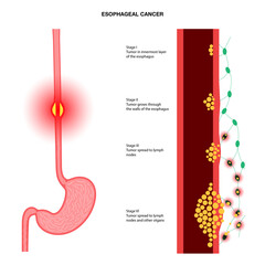 esophageal cancer stages - obrazy, fototapety, plakaty