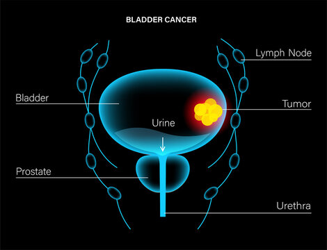 Bladder cancer stages