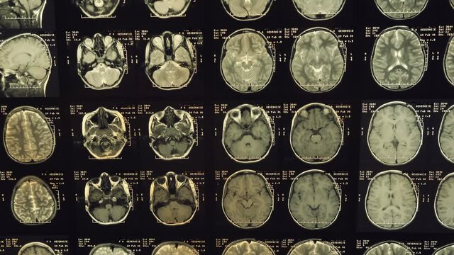 Magnetic resonance imaging (mri) of the human brain. Closeup. Macro