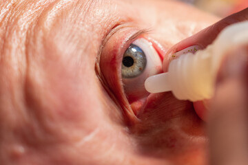 Woman drips drops into her eye. Treatment of eye disease. Eye drops.