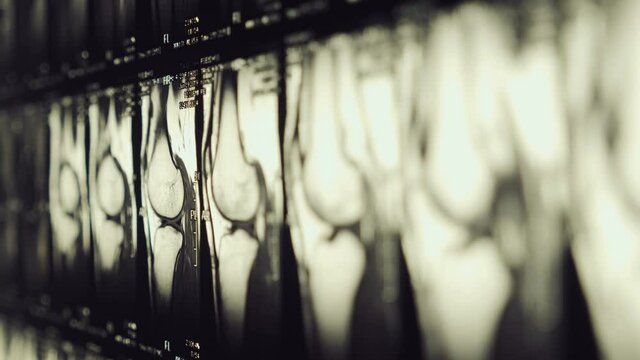 Magnetic resonance imaging (MRI) of the knee joint. Closeup. Macro