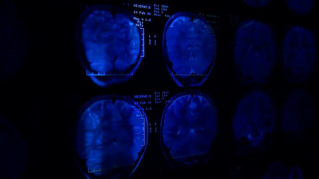 Magnetic resonance tomography (mri) of the human brain. Colorful flashes on the background of images of the brain. Closeup. Macro