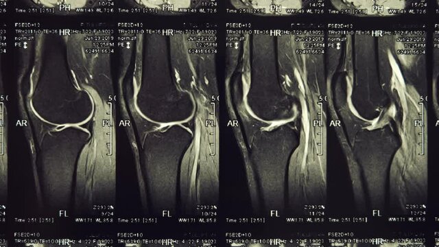 Magnetic resonance imaging (MRI) of the knee joint. Closeup. Macro