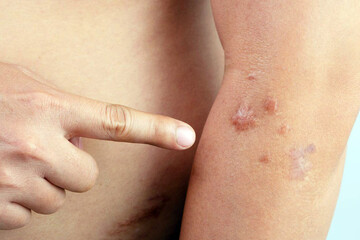 He pointed to the scars caused by the accident and the way to treat them.