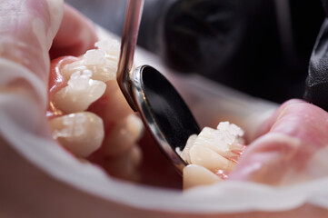 Close up of orthodontist checking patient teeth and braces with dental mirror. Person with cheek...