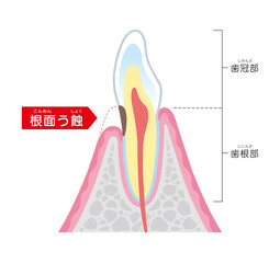 根面う蝕の図解イラスト