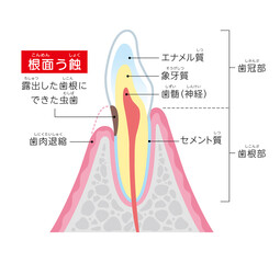 根面う蝕の図解イラスト