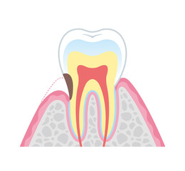 根面う蝕の図解イラスト