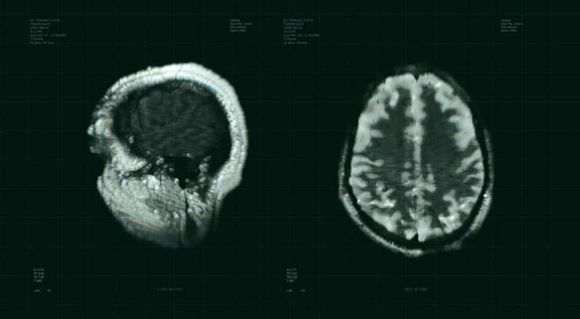 Brain scan visualization animation. Diagnosis data on laboratory display. Human illness research. Special medical equipment for tumor testing. Neurology test. X-ray. Tomography MRI, CT head examining