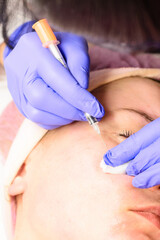 Miliums on the face, removal of hardened and mature milia by a beautician.