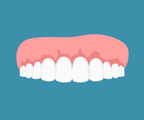 Gums Disease, Dentistry Flat Vector Concept. Dental Clinic, Stomatology Orthodontic Illness, Problem Illustration. Tooth Sickness Treatment, Oral Hygiene