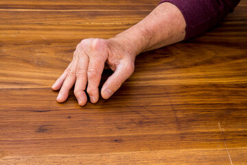 The hands of a male with Psoriatic Arthritis showing deviation of the Ulnar metacarpal joints.