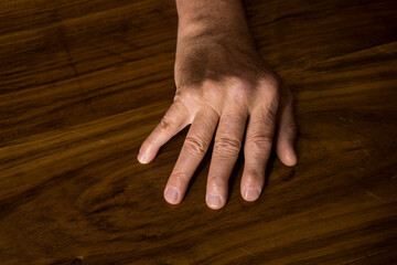 The hands of a male with Psoriatic Arthritis showing deviation of the Ulnar metacarpal joints. - obrazy, fototapety, plakaty