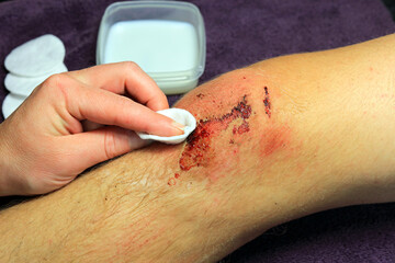 A Hand Using A Sterile Medical Wipe To Clean a Skin Abrasion On A Knee Injury.