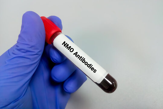 Blood Sample For NMO Antibodies Test, Diagnosis Of Neuromyelitis Optica (NMO)central Nervous System. Devic's Disease. Aquaporin 4 