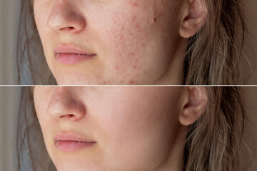 Cropped shot of a young woman's face before and after acne treatment on face. Pimples, red scars,...