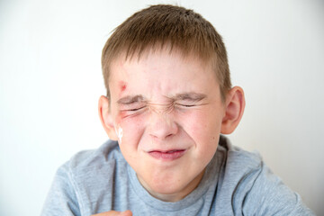 Pain from an abrasion on the boy's face. The wrinkled face of the child is in pain.