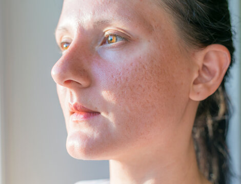 Woman with problematic skin and acne scars. 