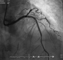 coronary angiogram (CAG) was performed post percutaneous coronary intervention (PCI) at mid part of left anterior descending artery (lad)