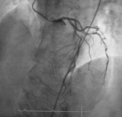 coronary angiogram (CAG) was showed left anterior descending artery (LAD) stenosis