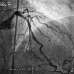 coronary angiogram (CAG) was showed left anterior descending artery (LAD) stenosis