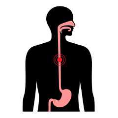 esophageal cancer concept