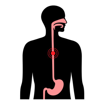 Esophageal Cancer Concept