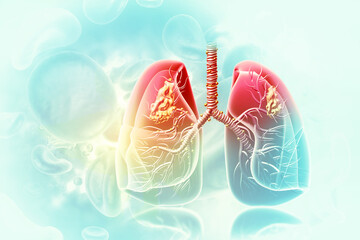 Medical Illustration showing lung cancer or bronchial carcinoma. 3d illustration - obrazy, fototapety, plakaty