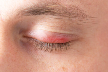 Fototapeta na wymiar Swelling of the eye. Swollen upper lid. Close up.