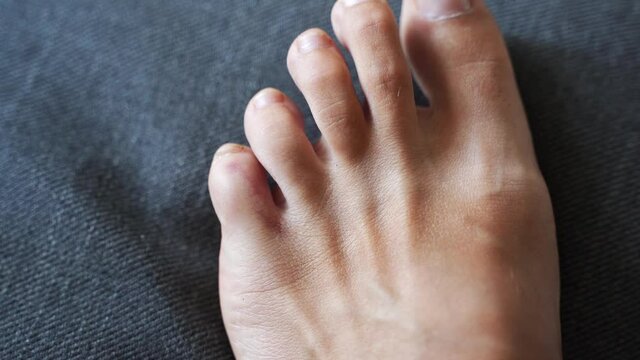 Foot little finger injury. Little toe pain and bruise after home accident. Phalange fracture. Barefoot fingernails healthy.