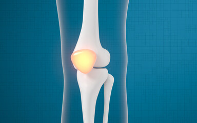 Leg bone and knee lesions, 3d rendering.