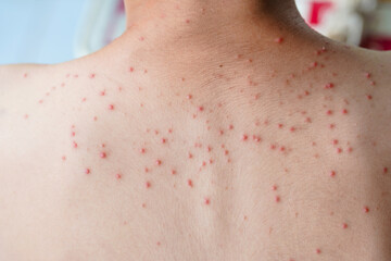 Acne on the back of a young man.