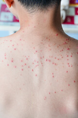 Acne on the back of a young man.