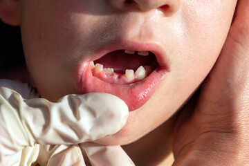 Open mouth of a boy with incorrectly growing teeth, caries of baby teeth, removed baby teeth,...