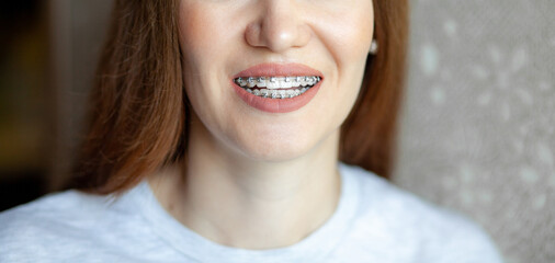 The smile of a young and beautiful girl with braces on her white teeth. Straightening of crooked...