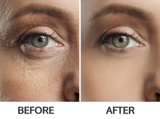 Middleage girl before and after acne treatment Skin Care