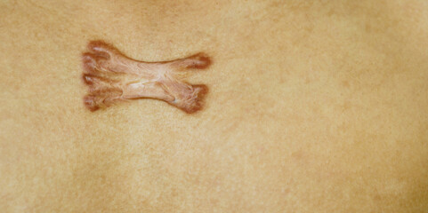 keloid scar on the chest of an Asian man. Inflamed and raised scars form on the skin caused by a single pimple