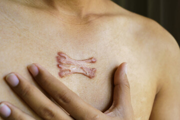 Hands-on the keloid scar area of an Asian dark-skinned man