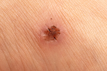 A wound on the skin of a person.