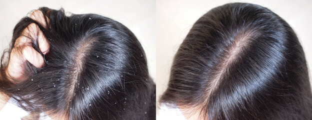 Image before and after anti dandruff treatment shampoo on hair woman.Problem health care concept.