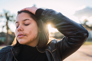 Portrait of beautiful teenage girl with a birthmark on her face with her eyes closed at sunset.