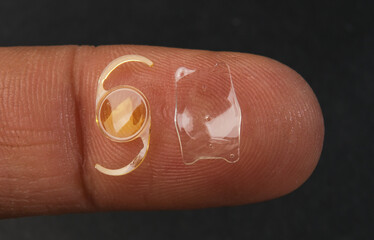 closeup photo of the implantable collamer lens ICL and intra ocular lens IOL