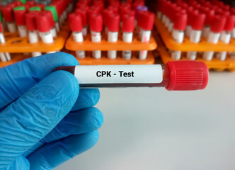 Blood sample for Creatine Phosphokinase (CPK) enzyme test with laboratory background. Diagnosis of muscle/tissue injuries. Myocardial infection. - obrazy, fototapety, plakaty