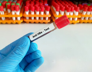 Blood sample for anti-HBe test. Anti HBe