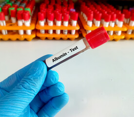 Blood sample tube for Albumin test. Diagnosis of liver disease. Hypoalbuminemia, Hyperalbuminemia. Nephrotic syndrome, hepatic cirrhosis, heart failure.