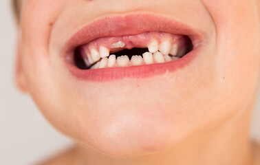 Obraz premium The smile of a child who has lost a baby tooth. Care for children's teeth.